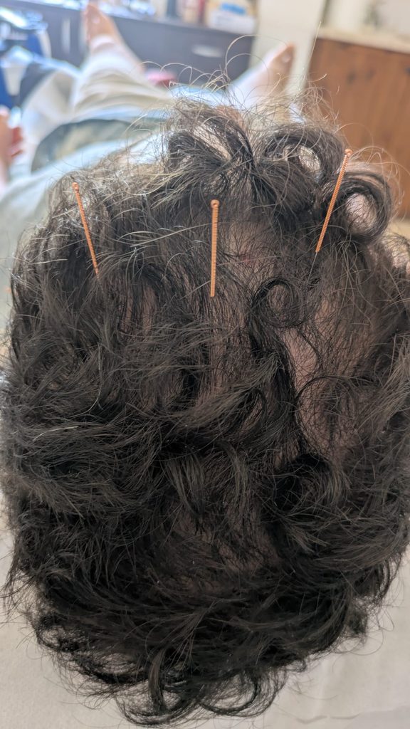 דיקור קרקפת יושם ישירות לאורך הקשת הפגועה של הראש.
